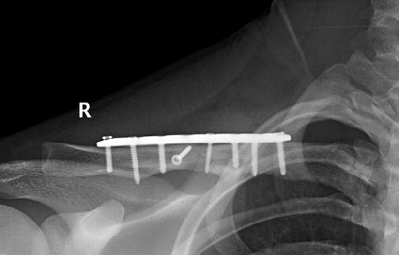 Fracture Fixation (Plating)