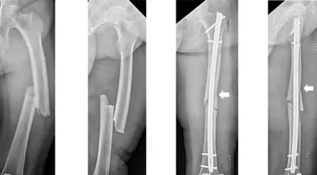 Fracture Fixation (Nailing)