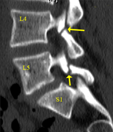 Pars defect(Fracture)