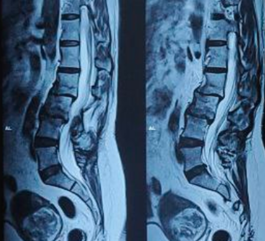 Degenerative Scoliosis
