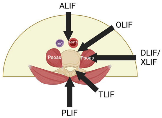 Spinal Fusion Procedure