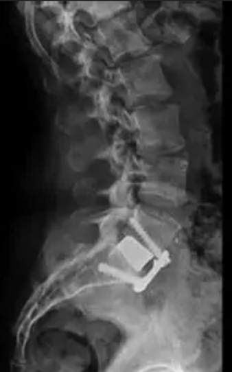 ALIF (Anterior Lumbar Interbody Fusion)