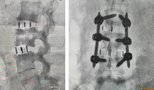 OLIF (Oblique Lateral Interbody Fusion)