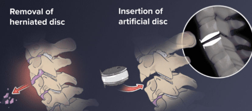 Insertion of artificial disc