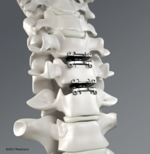 Cervical Disc replacemt