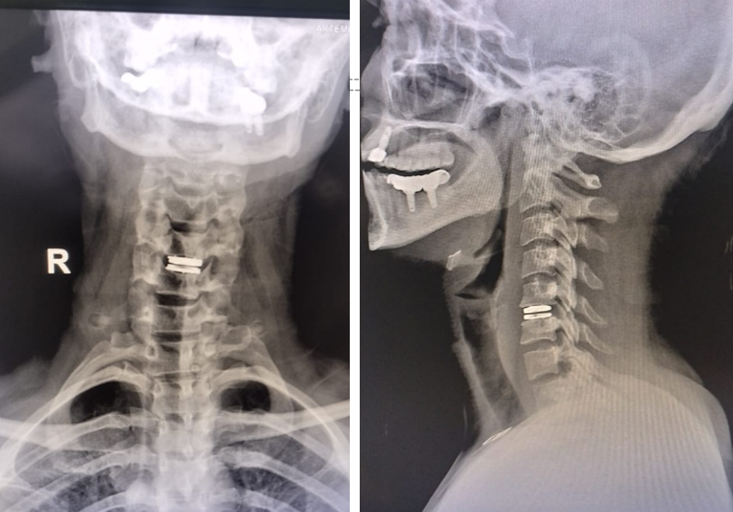 artificial disc replacement (ADR) procedure