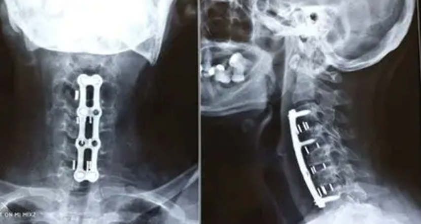 Anterior surgery (ACDF)