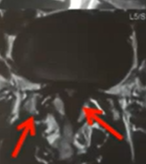 Lumbar Canal Stenosis