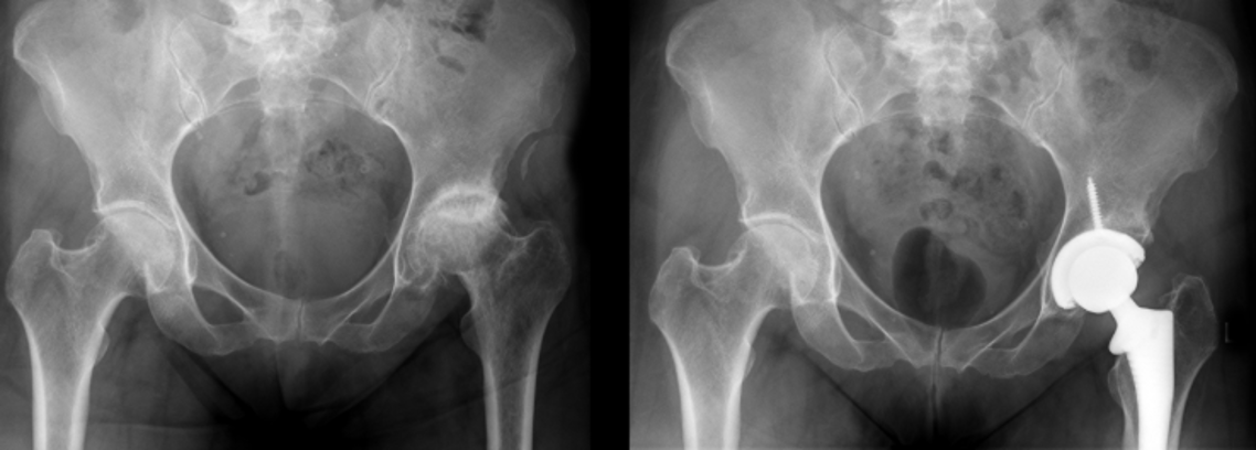 Total Hip replacement
