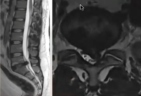 Disc removal Surgery (Microdiscectomy)