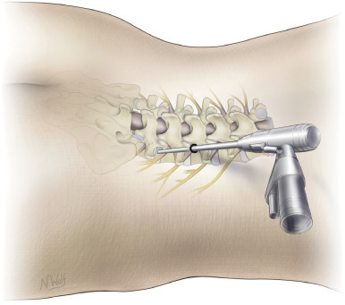 Endoscopic Spine Surgery