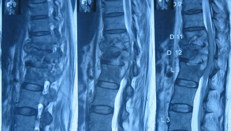 Spinal Infection Diagnosis