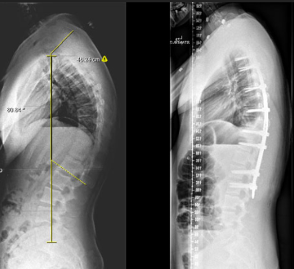 Kyphosis correction