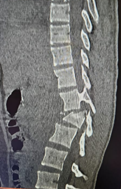 Spinal Fracture