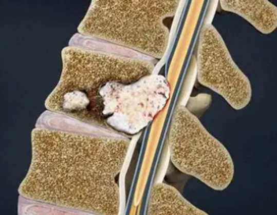 Benign (non-cancerous) or Malignant (cancerous)